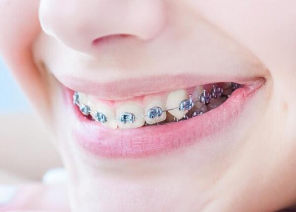 戴了牙套可以用電動(dòng)牙刷嗎？戴牙套的人群必看！