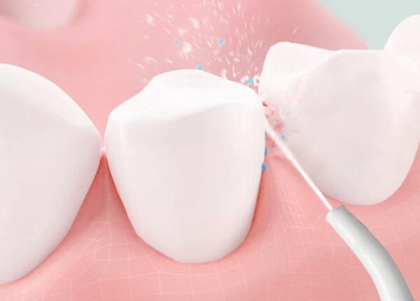 洗牙后用洗牙器好還是電動(dòng)牙刷？口腔清潔工具這樣選！